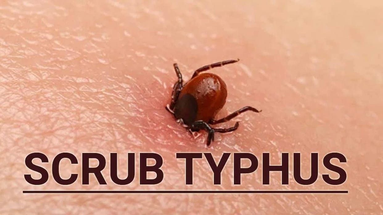 Five Cases Of Scrub Typhus In IGMC Shimla Himachal Pradesh