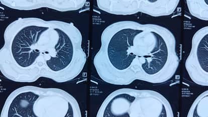 225 patients not collect CT scan reports