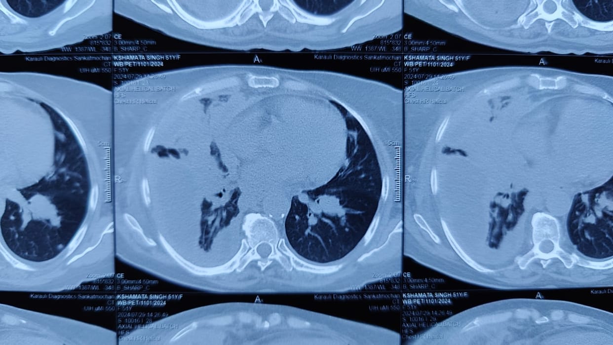 World Lung Cancer Day Lungs getting damaged more due pollution than cigarettes