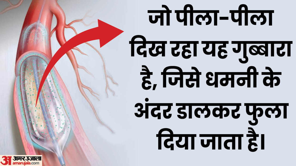 Balloon is opening blockage of heart No need for stunt relief for these patients