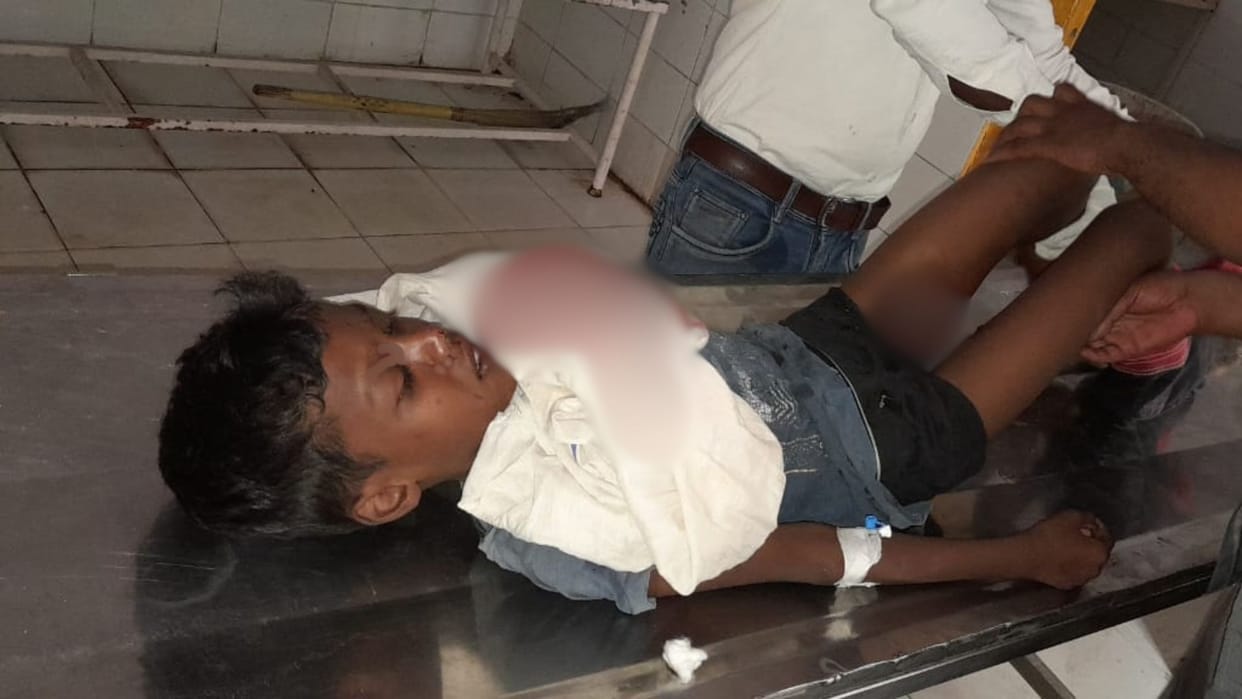 child injured when his mobile battery blasted while playing in sonbhadra