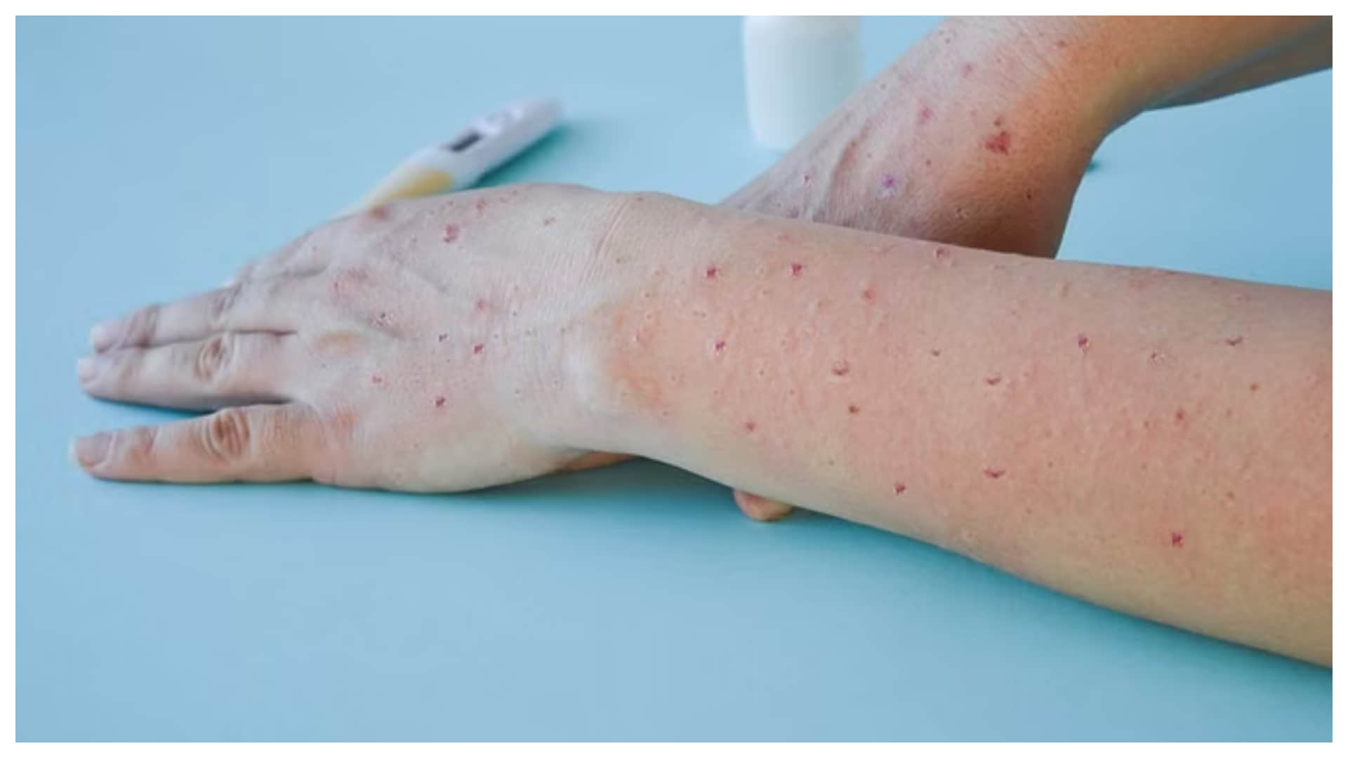 At least 610 people were killed due to monkeypox in Congo know its worldwide risk