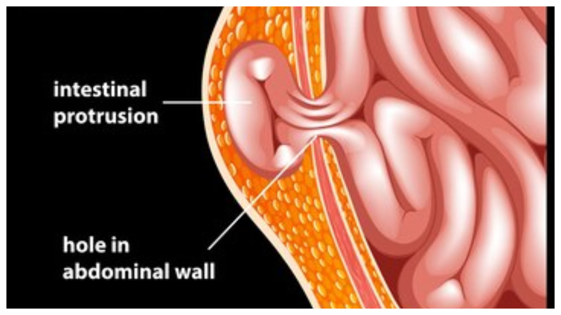 neeraj chopra hernia surgery know hernia causes symptoms and treatment in hindi