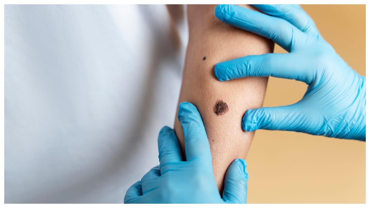 Monkeypox cases surge clade 1b mpox variant in uk know its symptoms and health risk