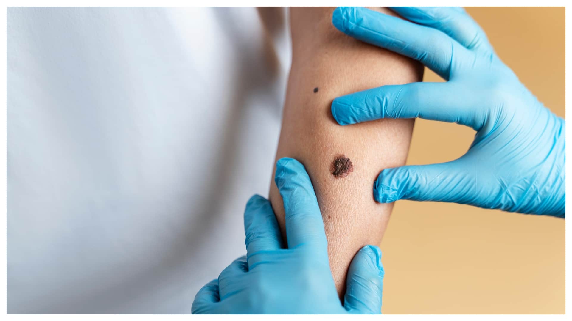 At least 610 people were killed due to monkeypox in Congo know its worldwide risk