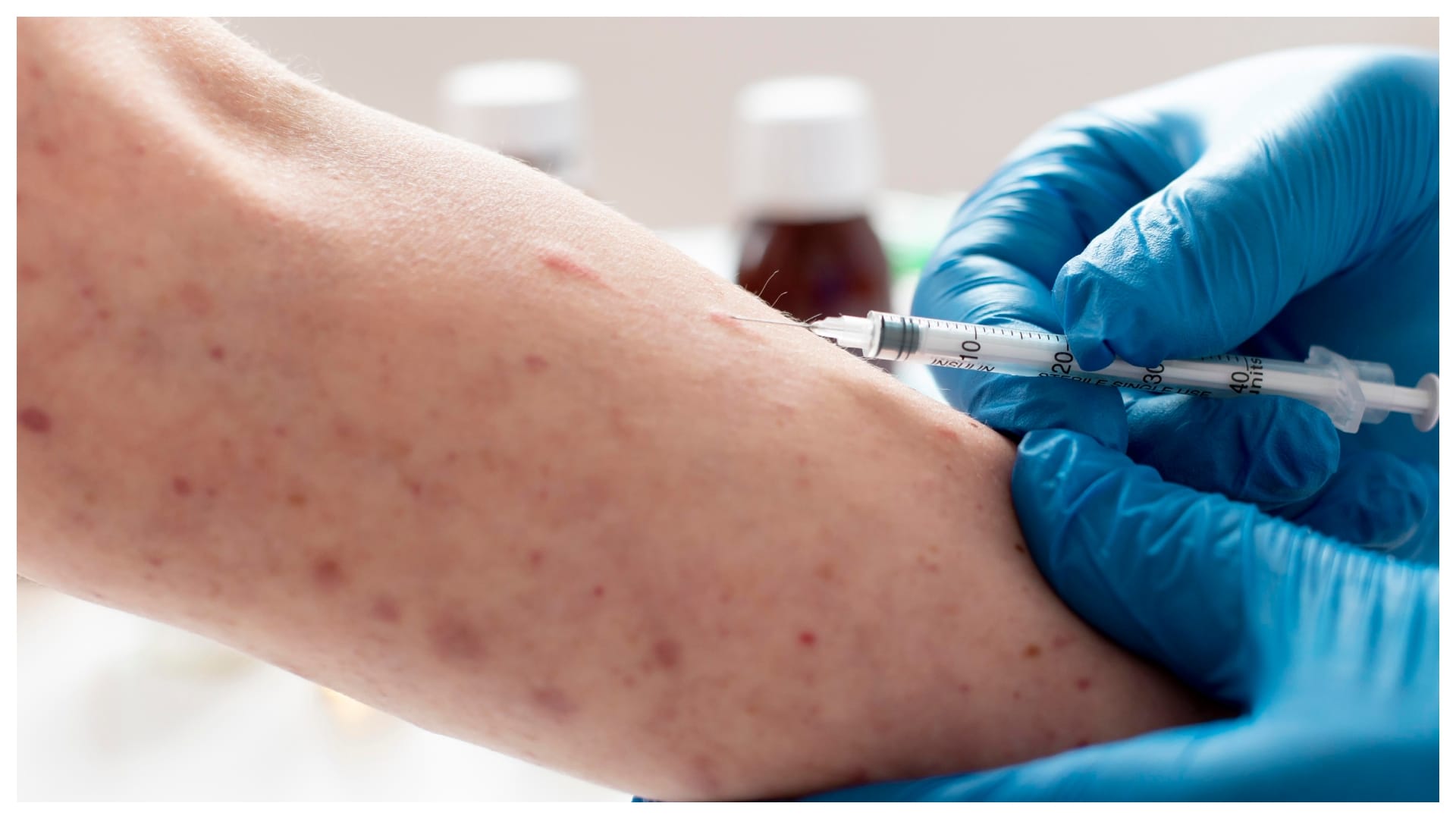 Symptoms of Monkeypox check here details