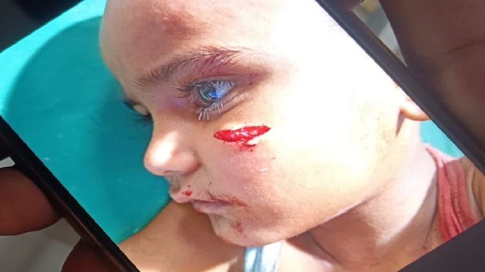 Meerut: Mad dog bit five people, three-year-old Vansh got 32 stitches