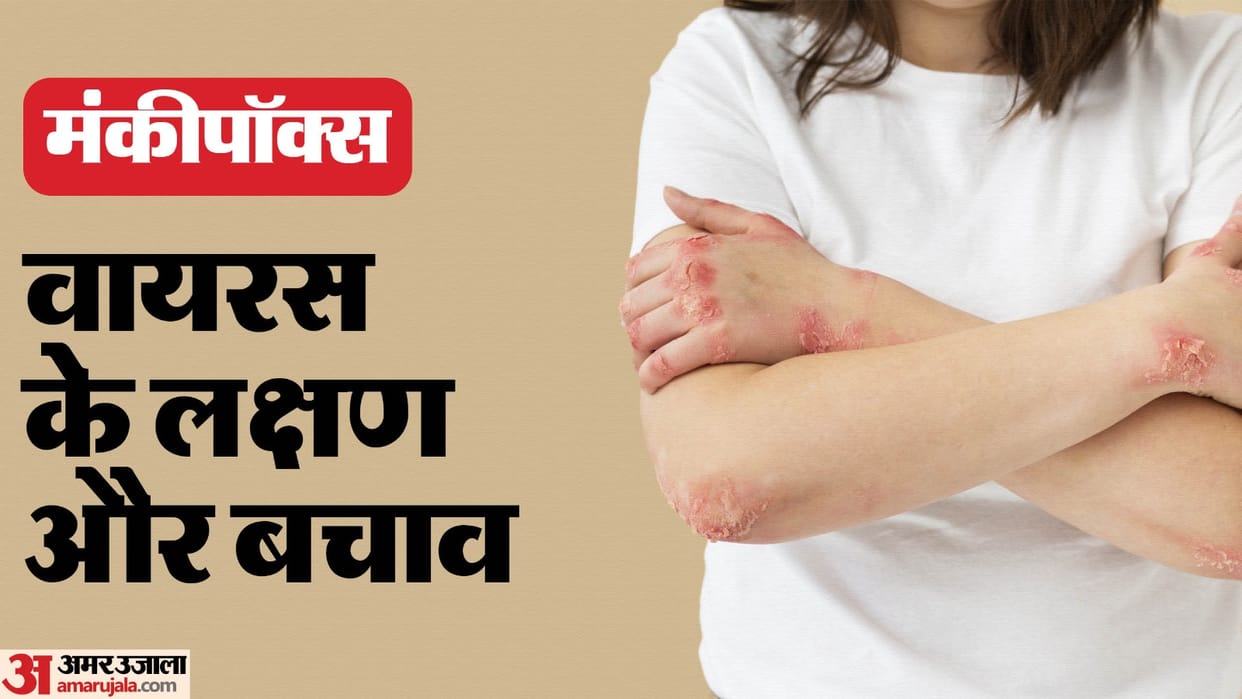 Monkeypox virus symptoms and prevention methods