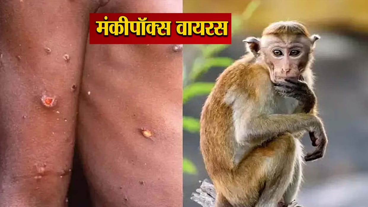 Alert in hospitals regarding monkey pox, guidelines received from center to health department