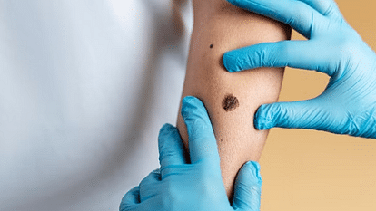 Suspected Mpox case found in India, investigation underway, Health Ministry alert know all updates