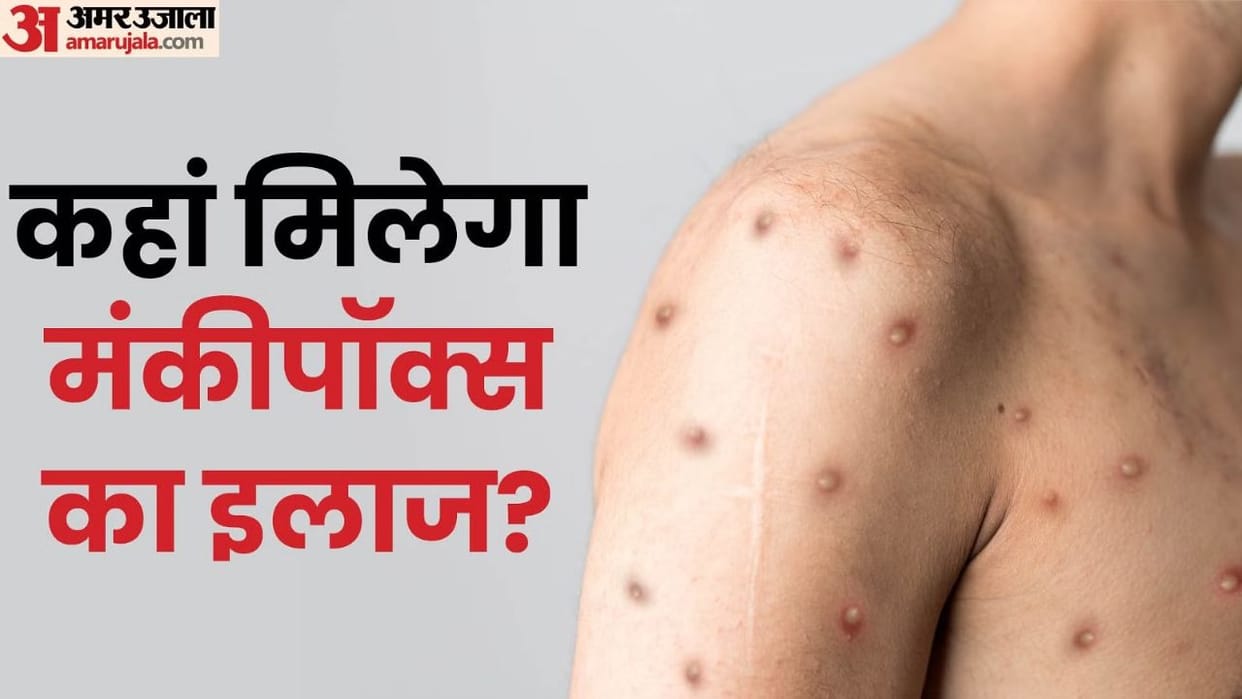 Alert issued regarding monkeypox in Himachal, know symptoms and prevention