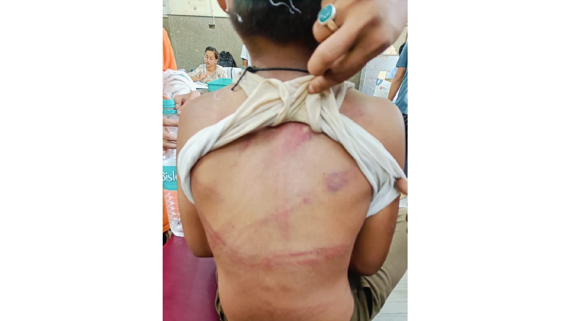 लड़के की पीठ पर मारपीट के निशान।