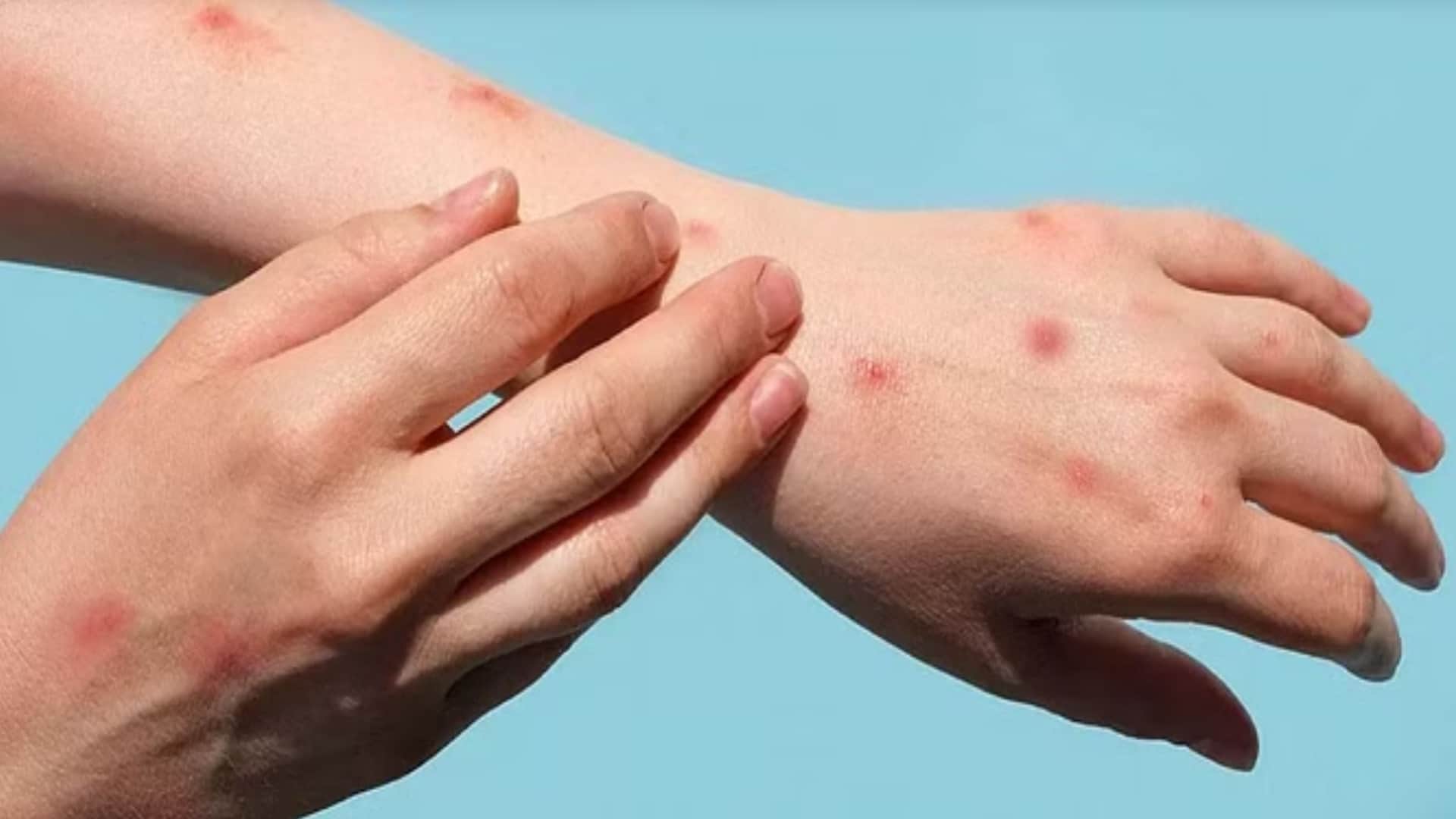 monkeypox latest news and updates in india know how mpox spread and its prevention