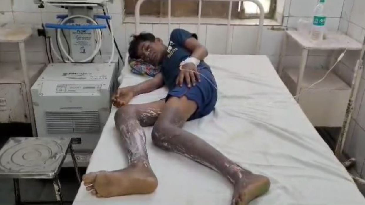 Alwar : Fire broke out due to leakage in gas cylinder, teenager who went to switch off the gas seriously burnt