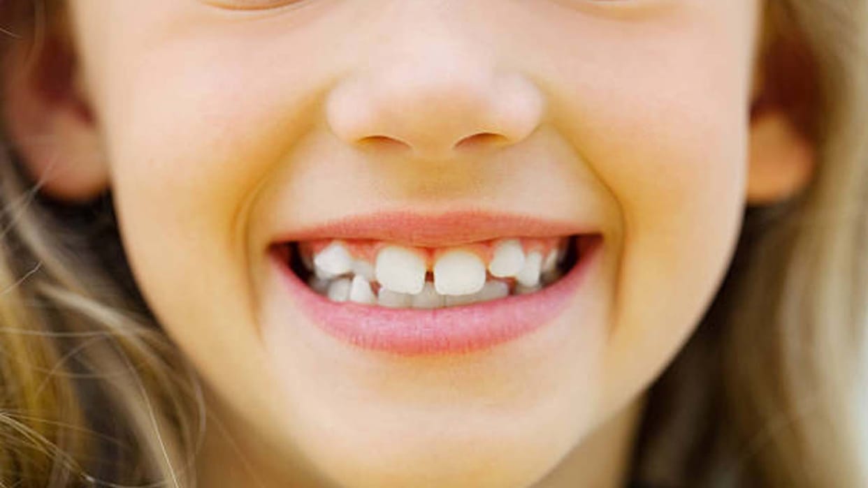 Kanpur: hobby of fast food is making girls' teeth crooked