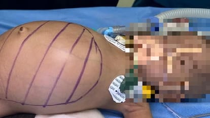 Lucknow: One and a half kg tumor came out from the stomach of a five kg girl, this is how the operation was do