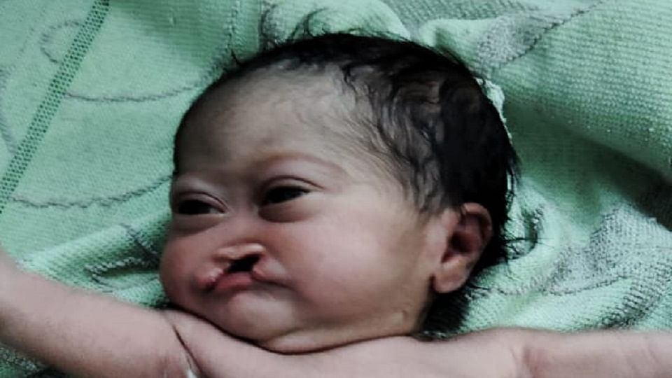 Bijnor: Bizarre face of the girl, her parents threw her away as soon as she was born, see the picture