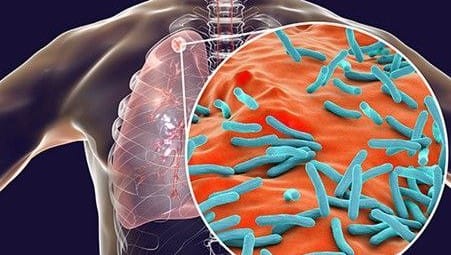 India tops WHO's global TB report other countries also advised to learn