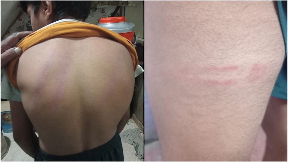 cruel teacher: student's back turned red while beating marks of brutality found everywhere on body