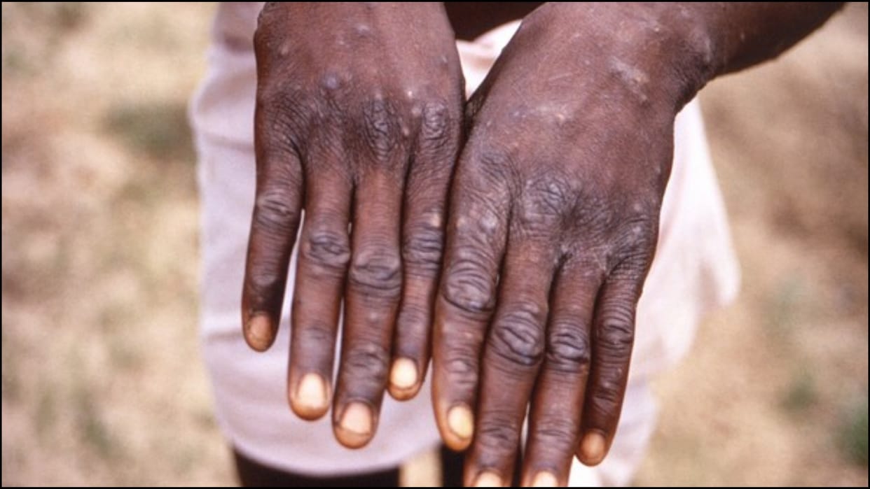 Suspected monkeypox infection reported from Malappuram in Kerala samples sent for testing news in hindi