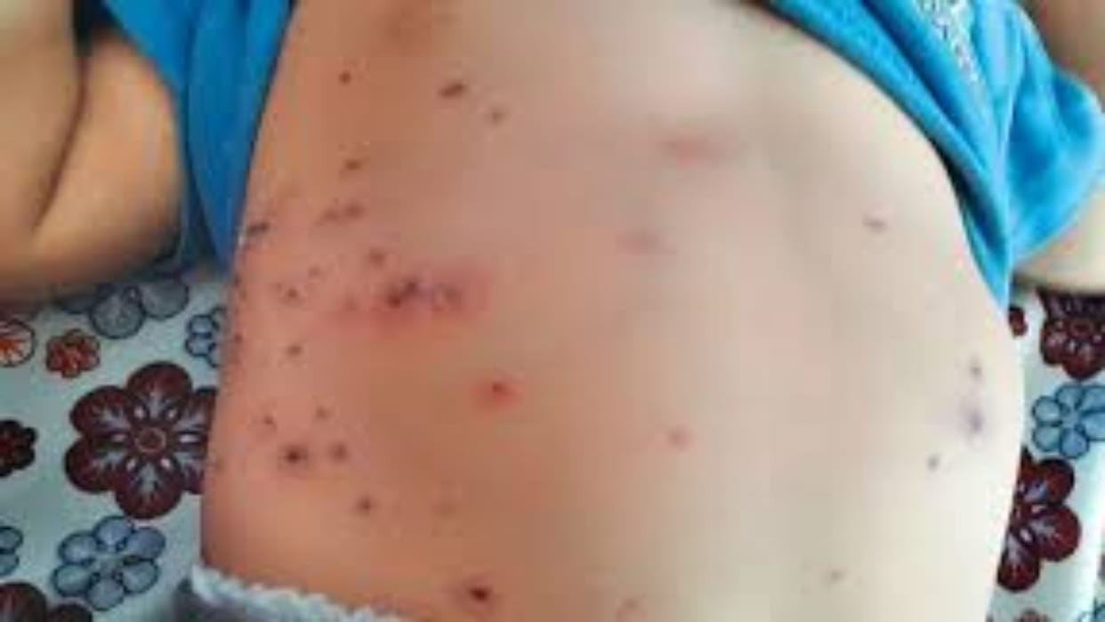 Kekri News: 2 patients of scrub typhus found, this infectious disease spreads to humans due to animals
