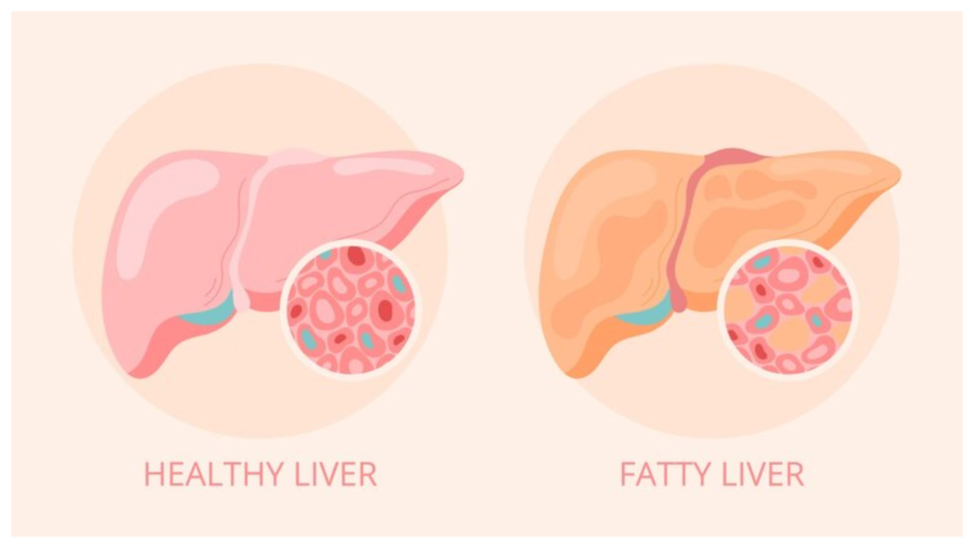 Health Tips Fatty Liver Symptoms Causes Treatment know how does weight loss help fatty liver
