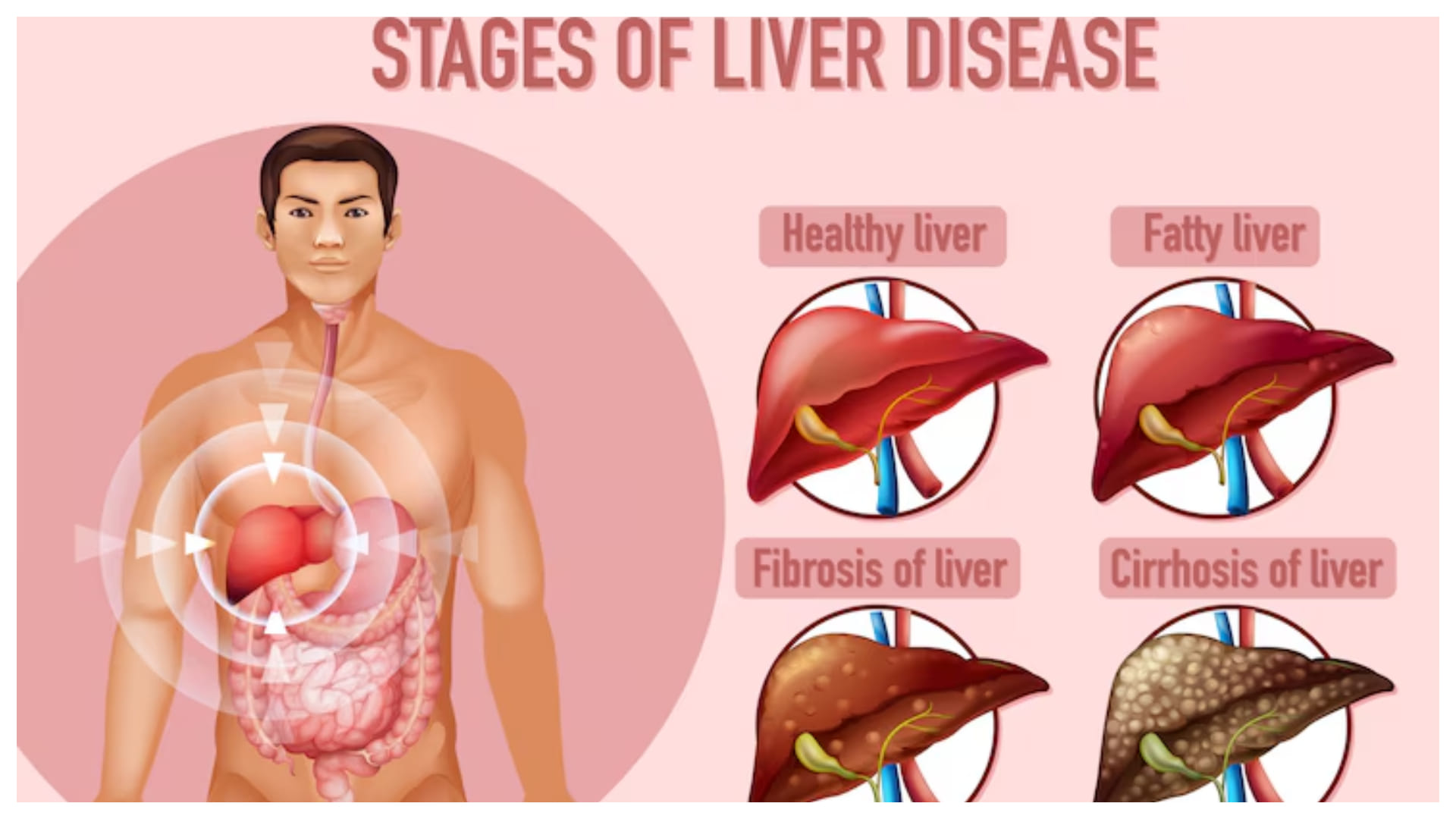 One to three of 10 people are being diagnosed with non-alcoholic fatty liver disease in india