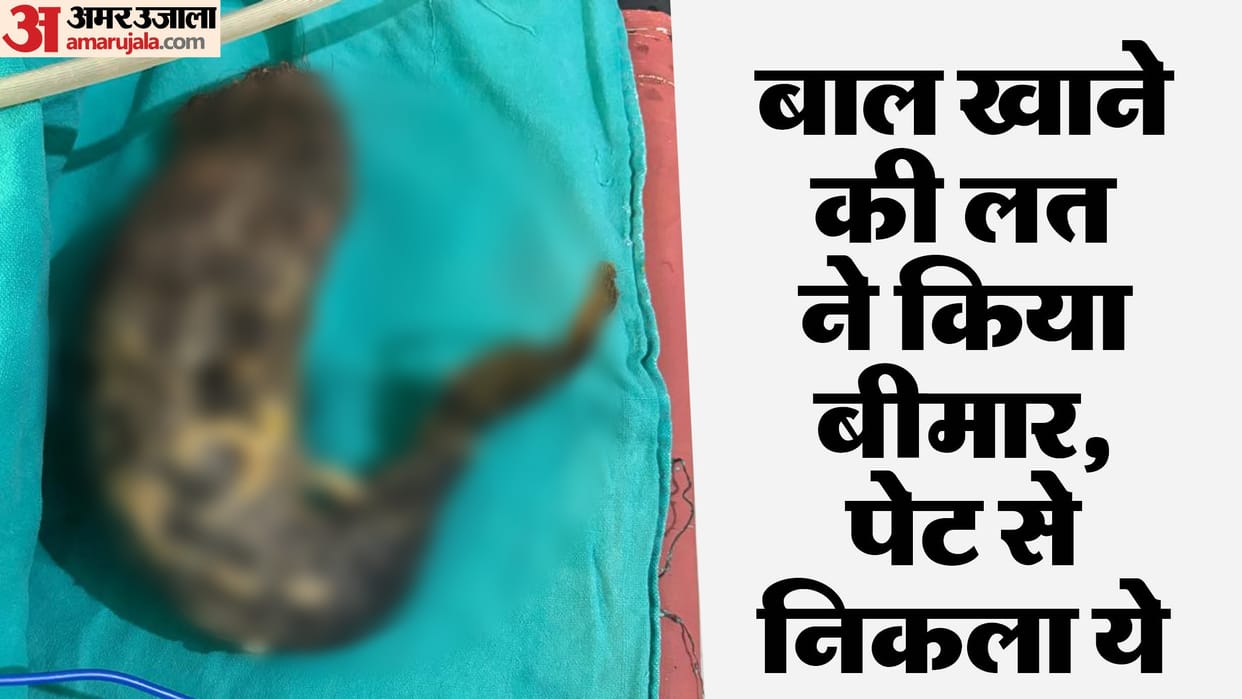 doctors removed two kg bunch of hair from the girl stomach by surgery in bareilly