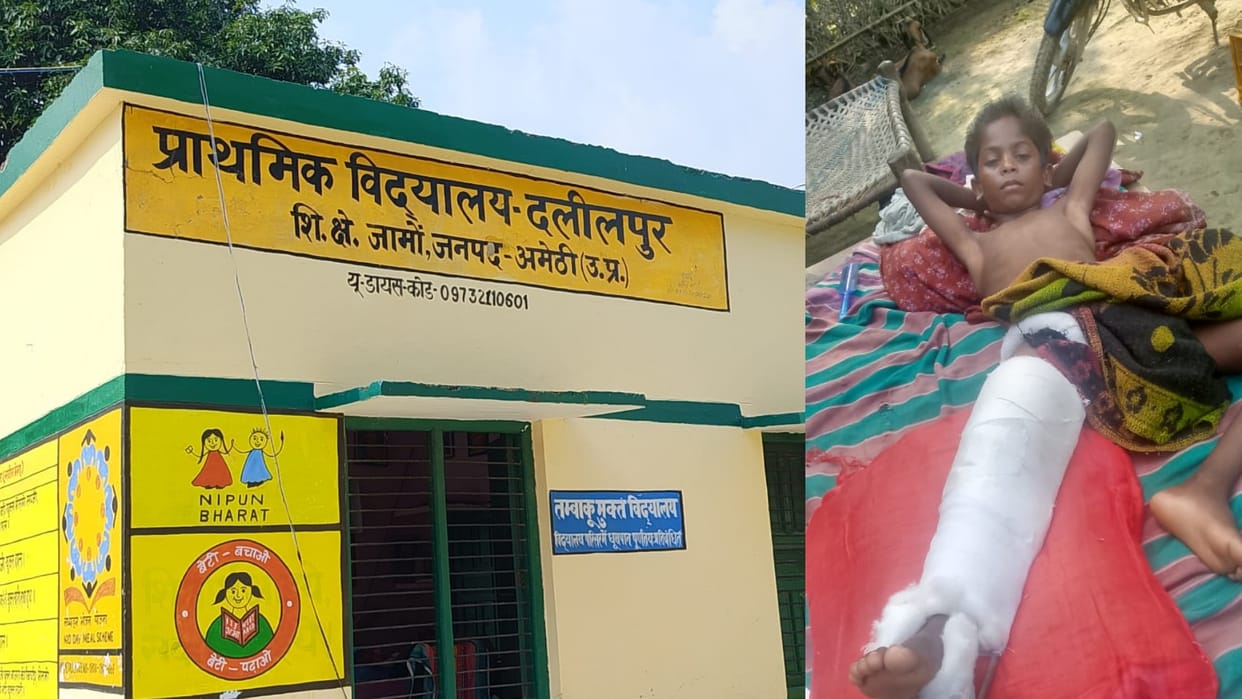 Amethi: Teacher beats student badly for not coming to school, leg fractured
