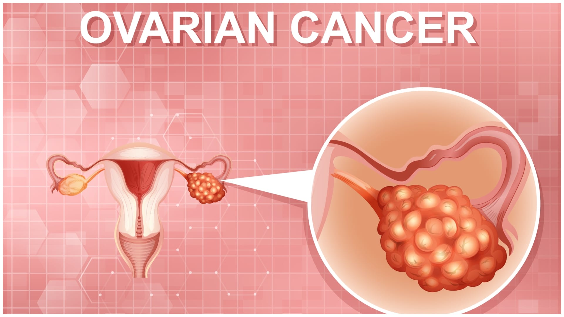 first ever ovarian cancer vaccine OvarianVax to eliminate the disease