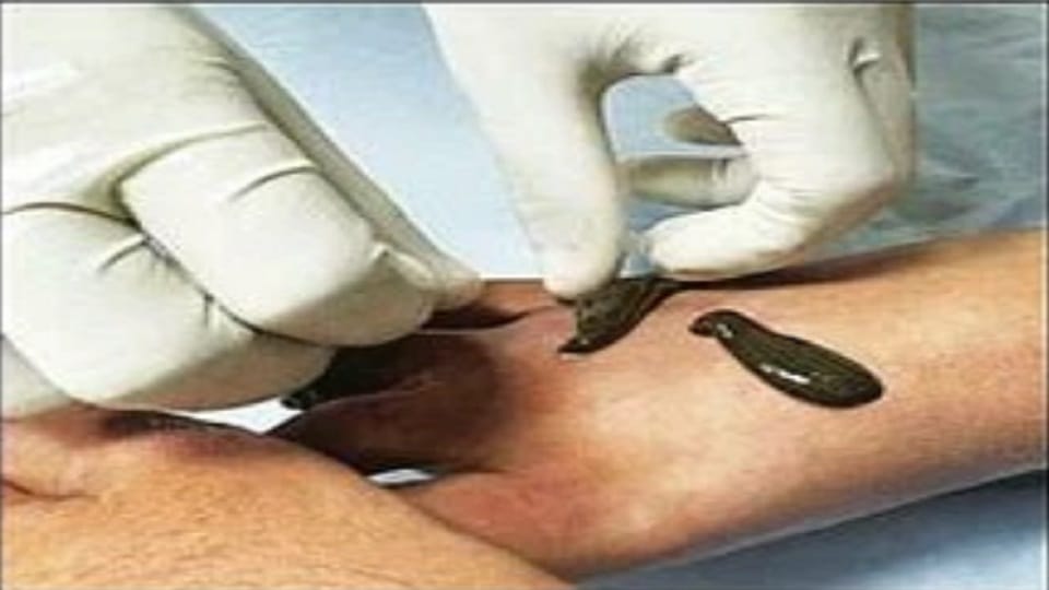 Leech is sucking contaminated blood, body is becoming healthy