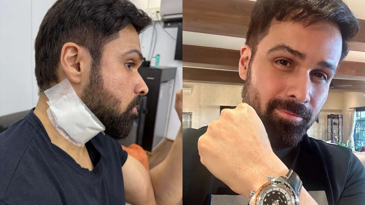 Emraan Hashmi got injured on Sets of Goodachari 2 during shooting an action stunt scene in Hyderabad