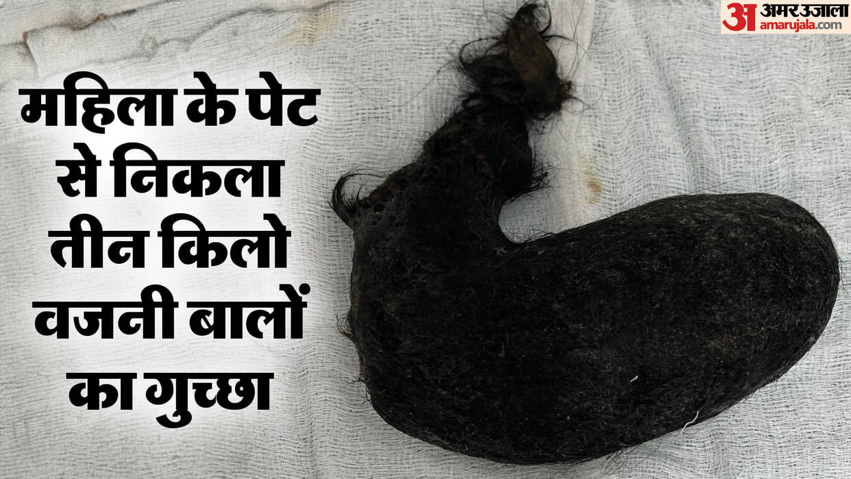 Jodhpur News: A three kilo clump of hair came out of a woman's stomach