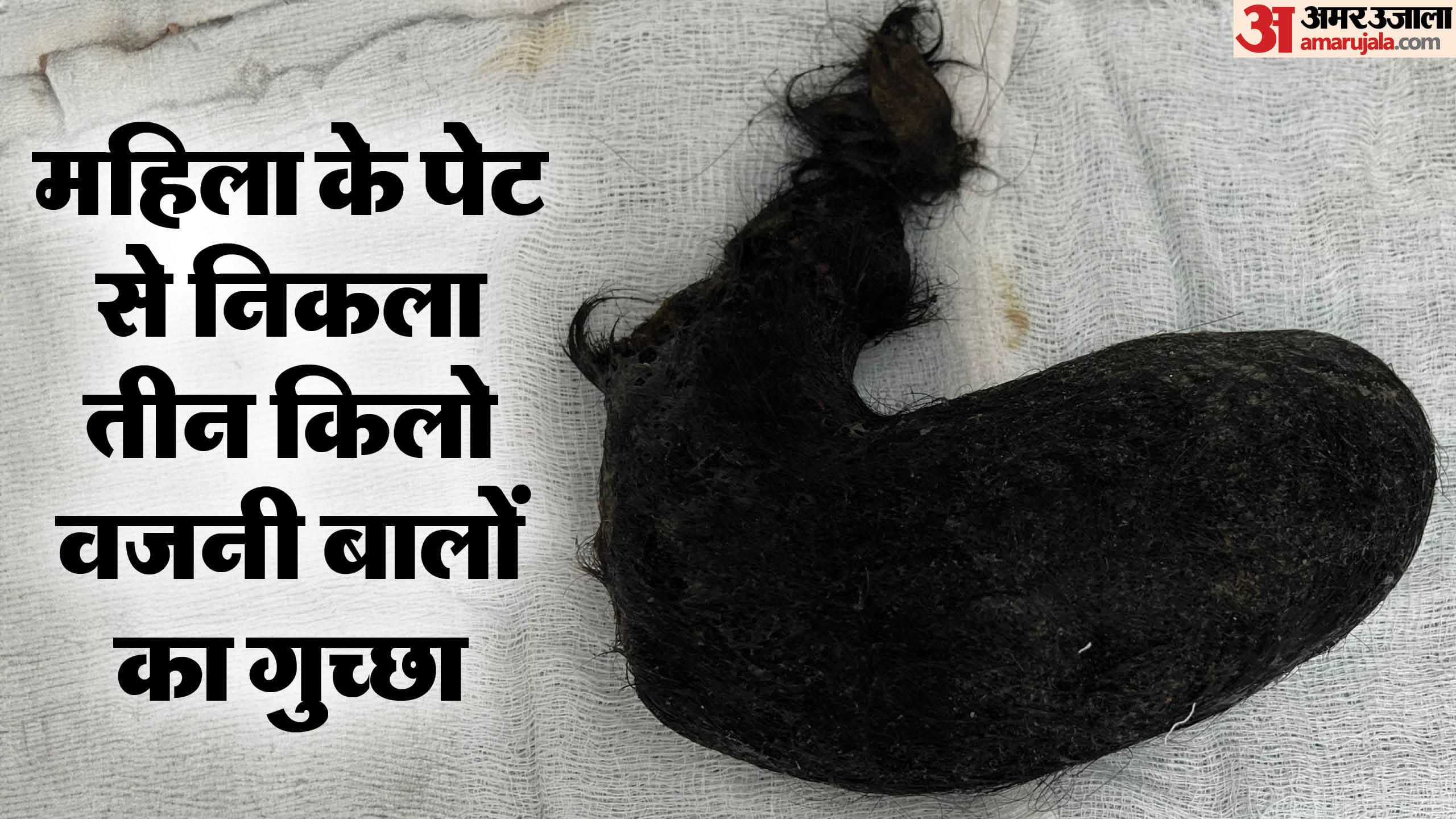 पेट से निकला बालों को गुच्छा।