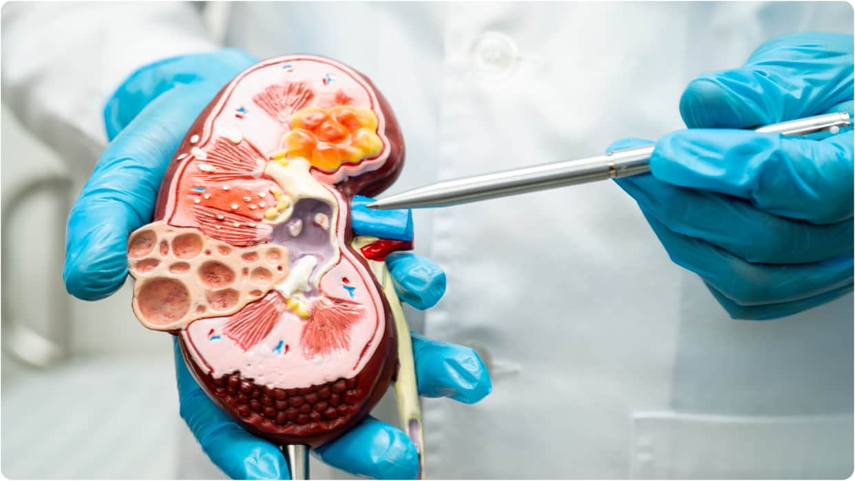 world kidney cancer day 2025 what causes kidney cancer and how to prevent it