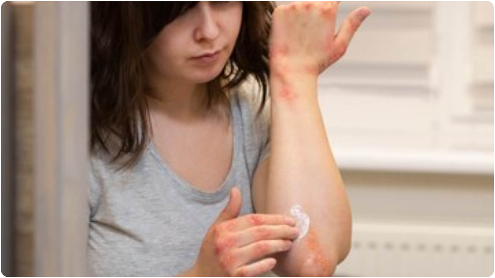 is it good to apply toothpaste on burns kya jalne par toothpaste lagana chahiye