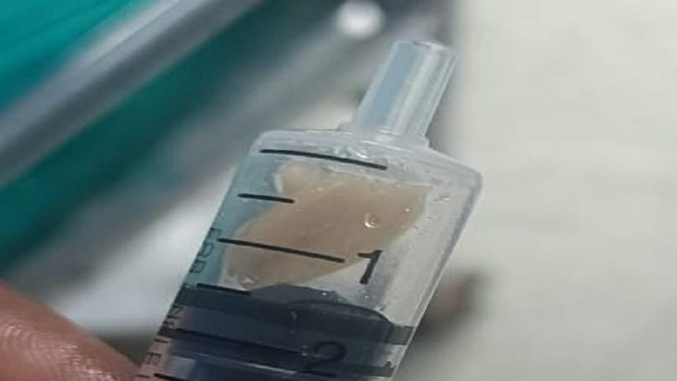 peanut seed got stuck in the windpipe of a nine month old innocent doctors of SN saved his life