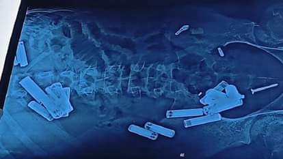 आदित्य के पेट  के अल्ट्रासाउंड में दिखते घड़ी में लगाने वाले सेल, ब्लेड व चौबा