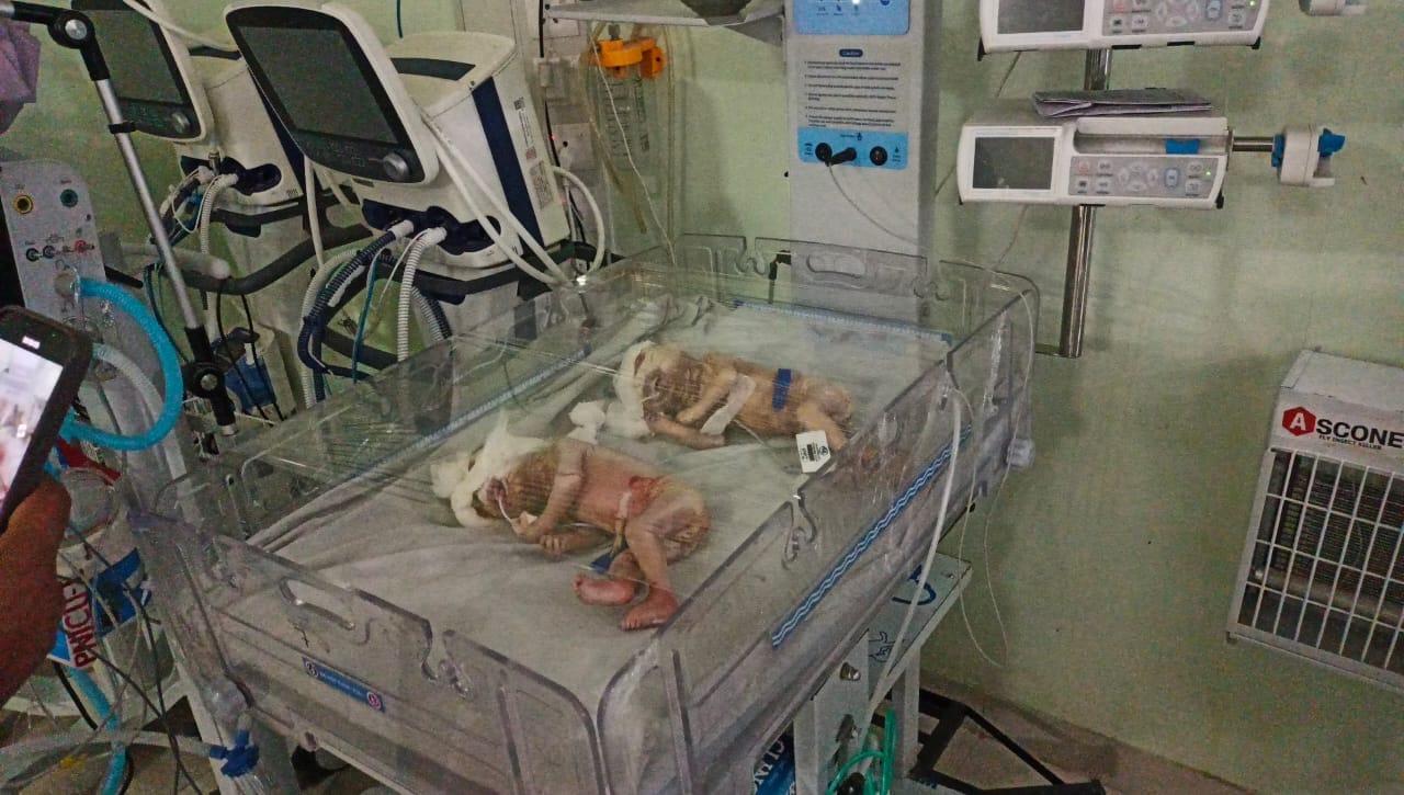 Bikaner News: Children who look like aliens born treatment in Bikaner hospital doctors surprised