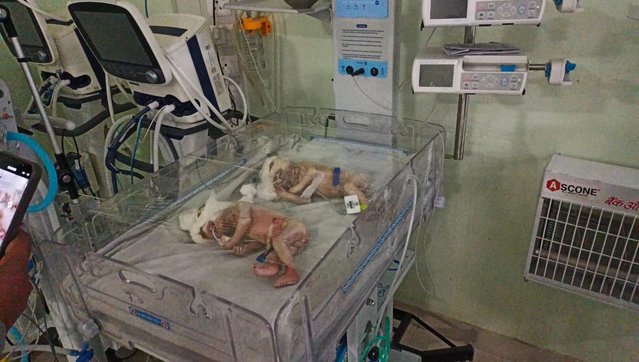 Bikaner News: Children who look like aliens born treatment in Bikaner hospital doctors surprised