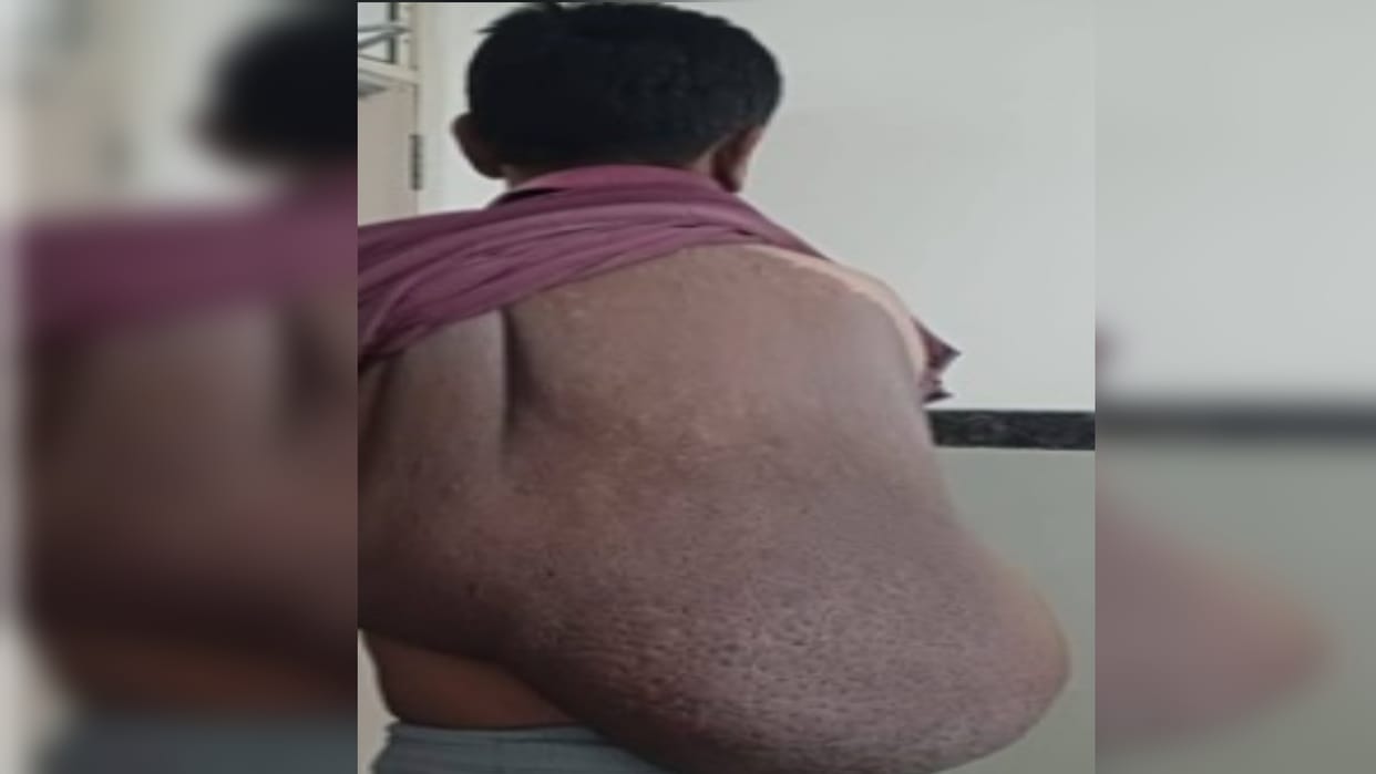 15 kg tumor removed from youth's back in SRN, operation lasted for seven hours