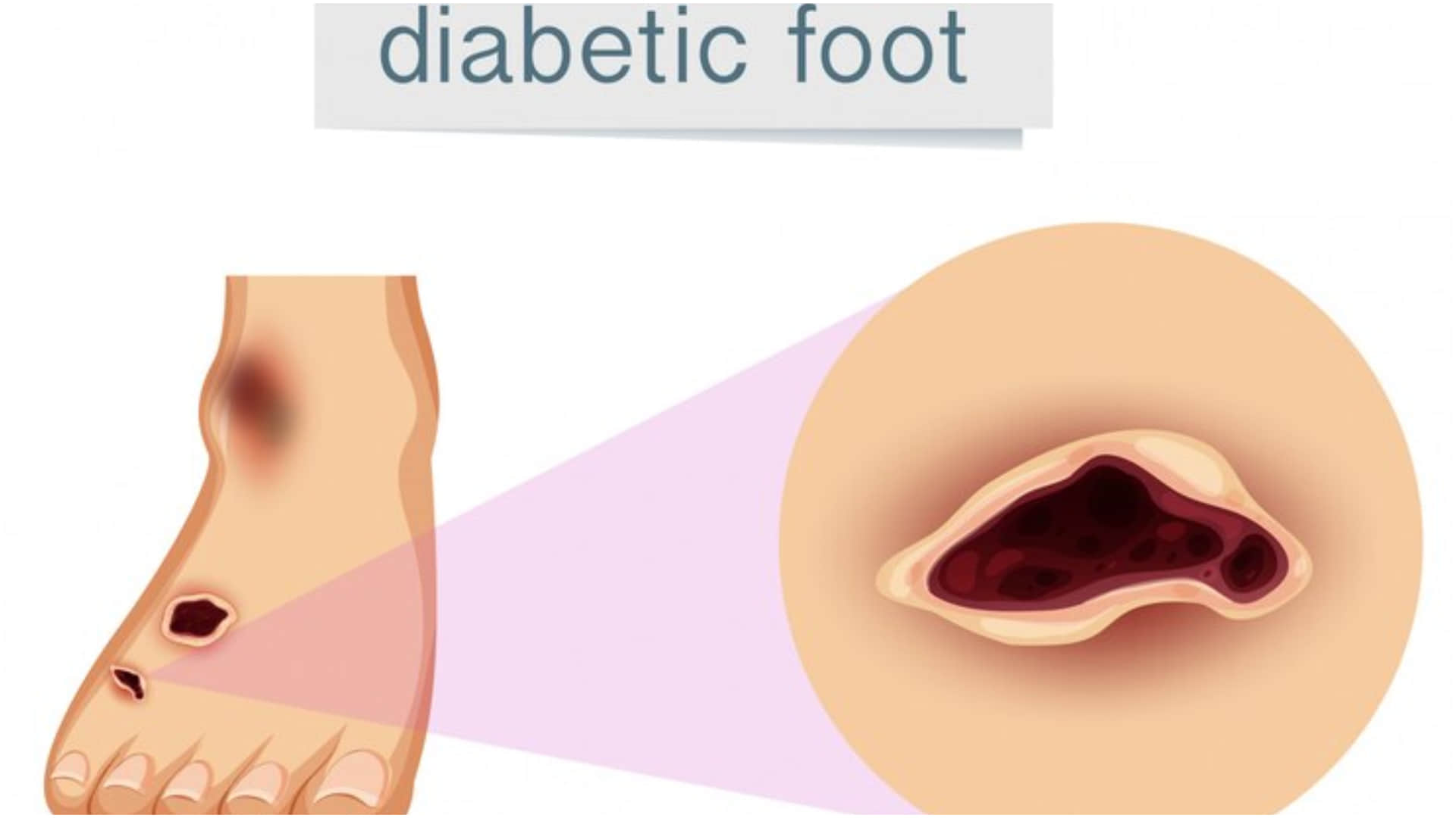 World Health Day 2025 foot amputation due to diabetic foot ulcers what is diabetic foot problem