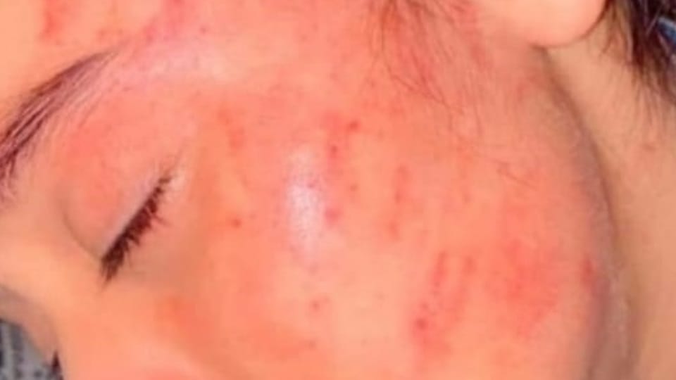 Eight year old girl beaten by teacher, case registered in Banur