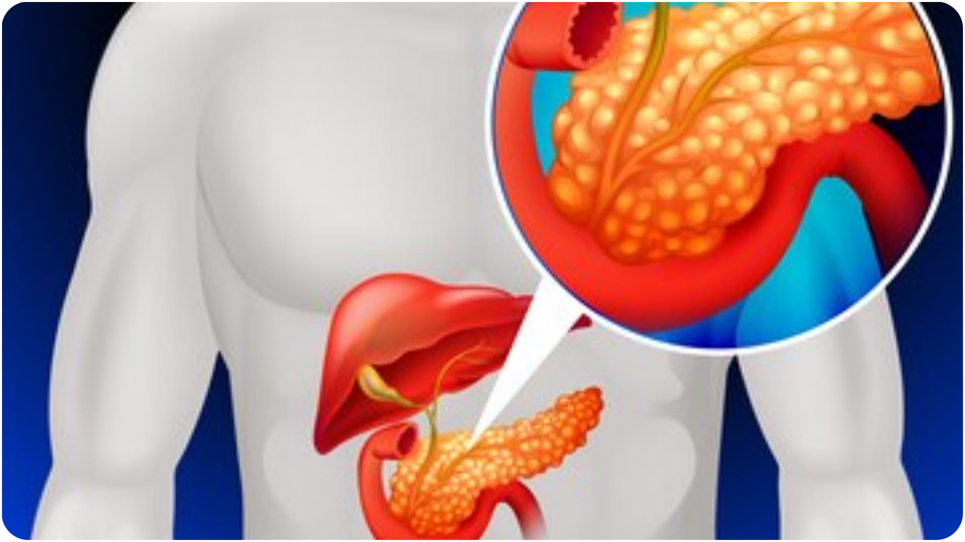 world pancreatic cancer day 2024 what is pancreatic cancer and symptoms know its prevention in hindi