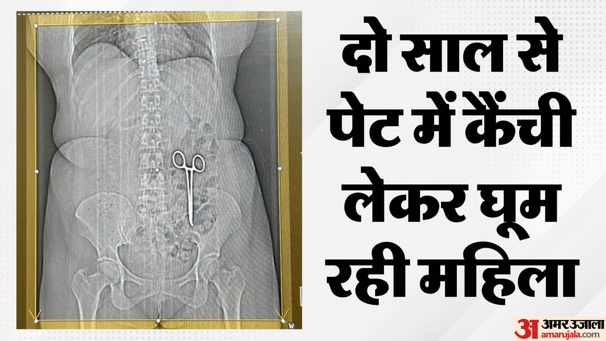 MP Bhind News: Scissors in woman's stomach suffering from pain for two years