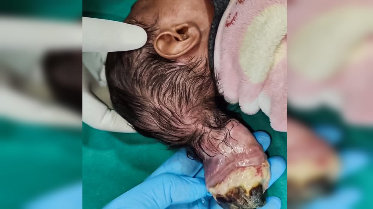 two-headed newborn baby was operated upon and given new life, doctors said - it is encephalocele disease