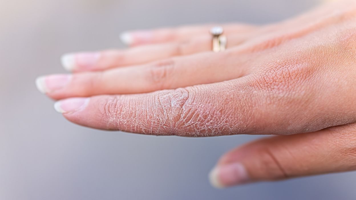Winter Skin Care Home Remedies For Dry Hands And Skin In Hindi - Amar Ujala  Hindi News Live - Winter Skin Care:सर्दियों में रूखेपन से फटने लगी है  हाथ-पैरों की त्वचा तो