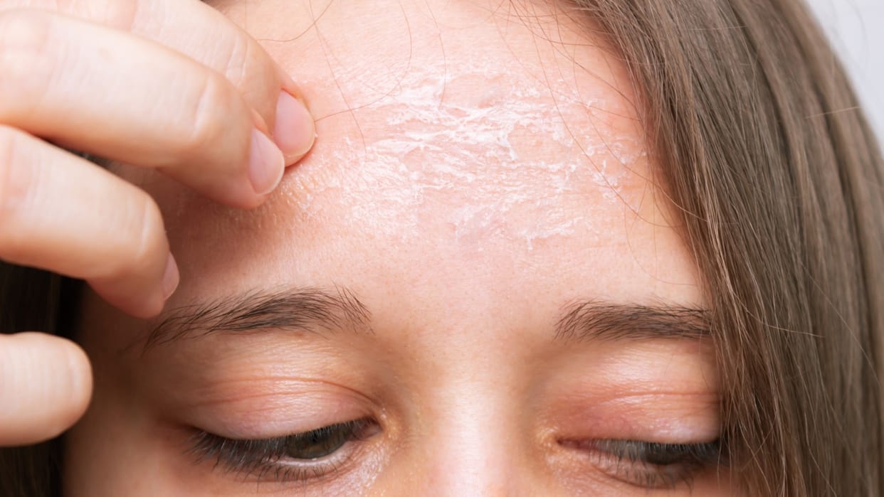 Winter Skin Care Tips Know How to Get Dry Skin on Forehead Remove Cracks