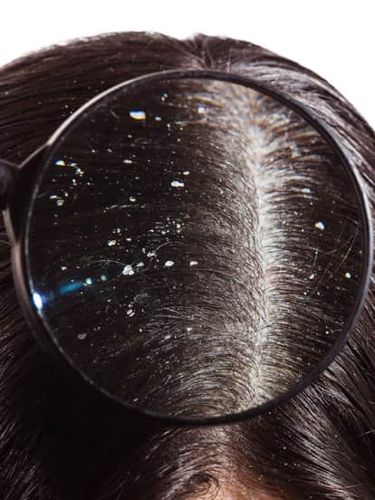 dandruff