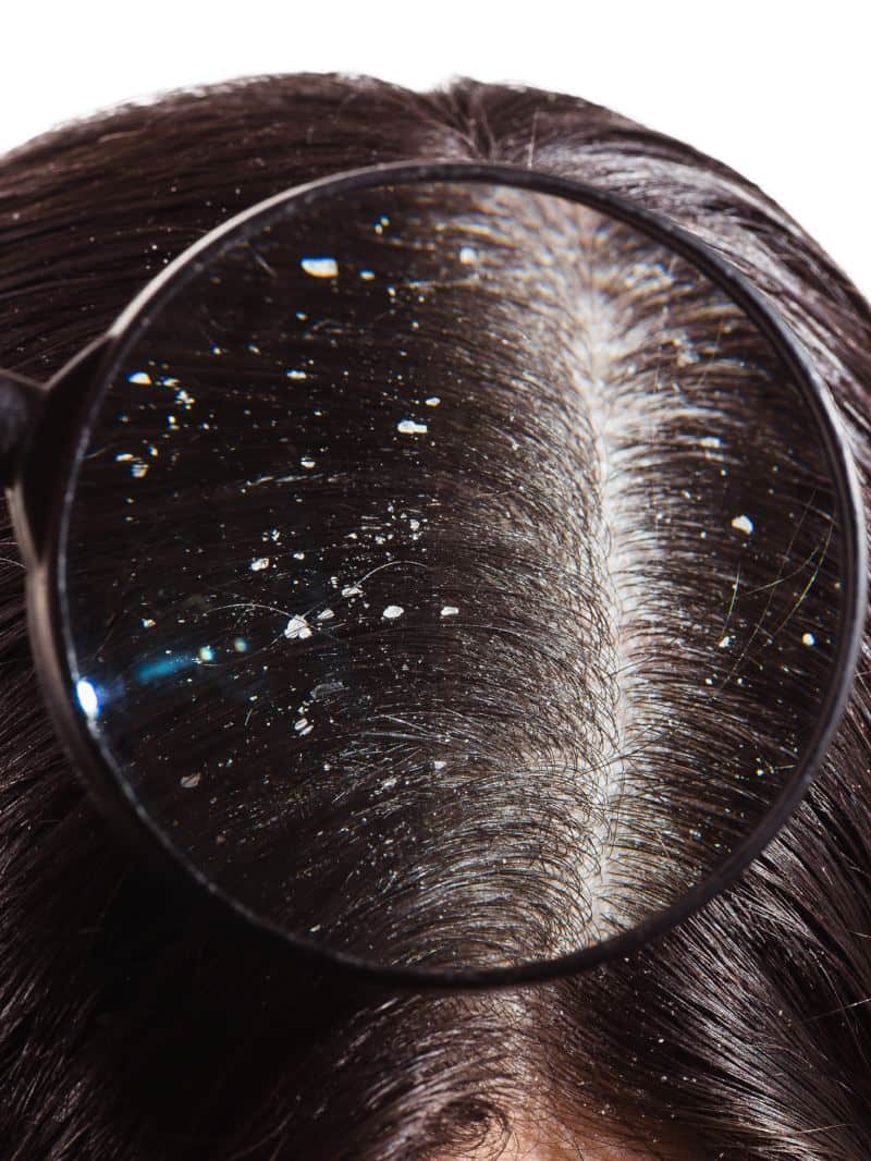 dandruff